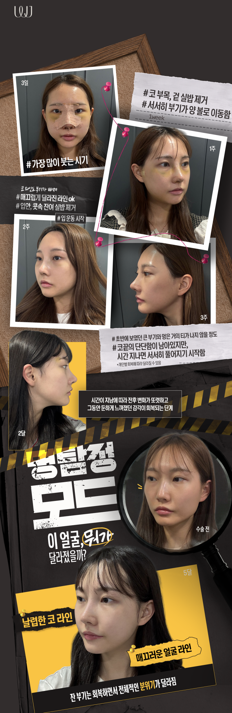 사각턱고민 윤곽3종, 코성형 전후와 회복과정