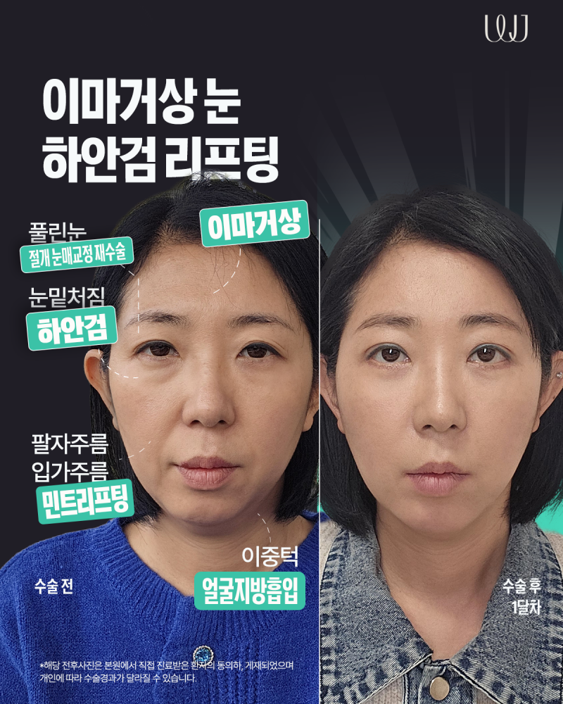 이마거상,눈재수술,하안검 중년성형 전후 회복과정