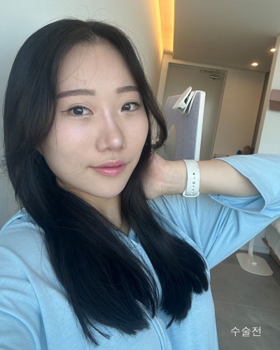 돌출된 광대 윤곽3종 전후와 회복기간 사진 10
