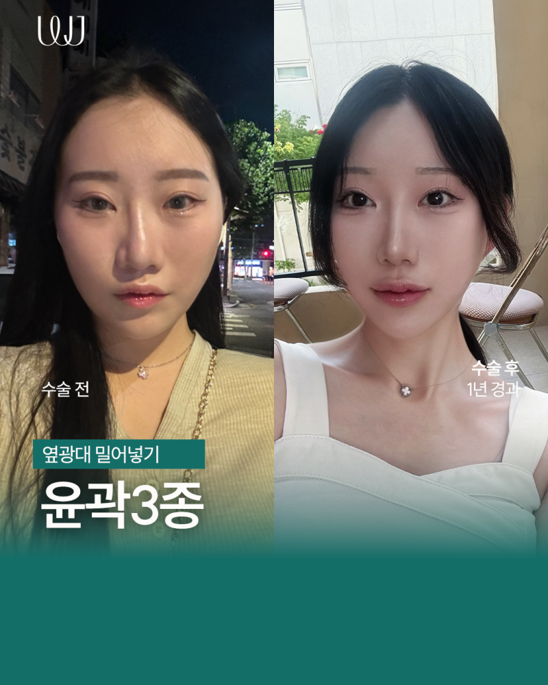 돌출된 광대 윤곽3종 전후와 회복기간