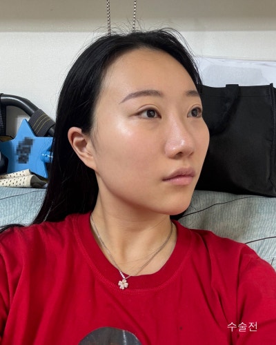 돌출된 광대 윤곽3종 전후와 회복기간 사진 6