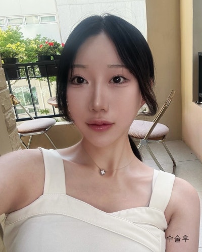 돌출된 광대 윤곽3종 전후와 회복기간 사진 3