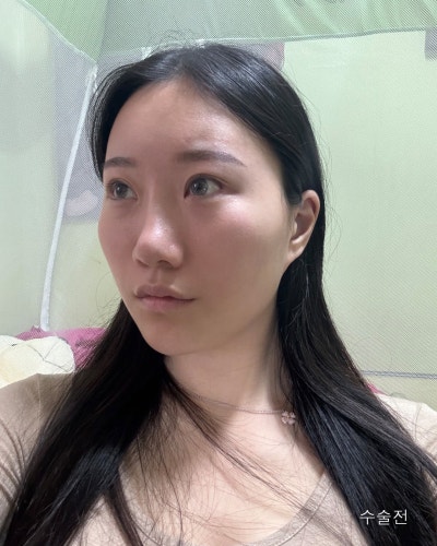 돌출된 광대 윤곽3종 전후와 회복기간 사진 4