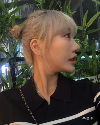 돌출된 광대 윤곽3종 전후와 회복기간 사진 9