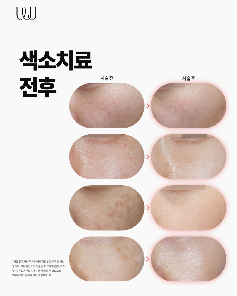 피부과 색소레이저 효과 극대화하기 위해서는?