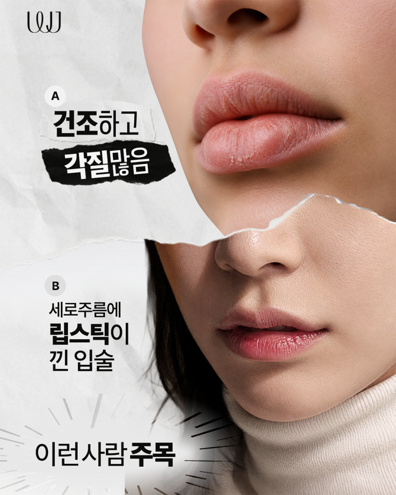 립쥬란,립쥬엔과 입술필러 차이점은?