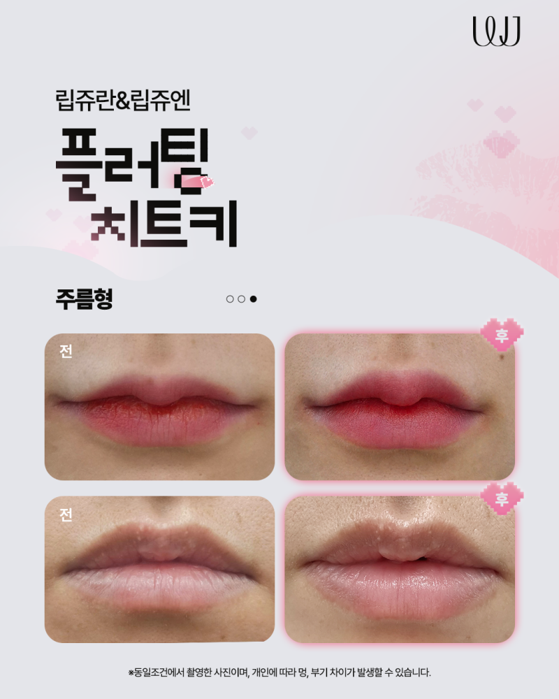 Lipjuran, Lipjuen กับฟิลเลอร์ปาก แตกต่างกันอย่างไร? 사진 5