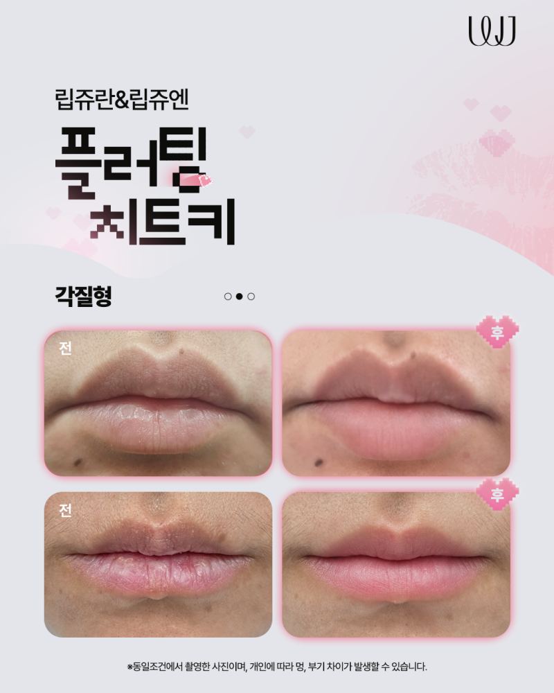 Lipjuran, Lipjuen กับฟิลเลอร์ปาก แตกต่างกันอย่างไร? 사진 4