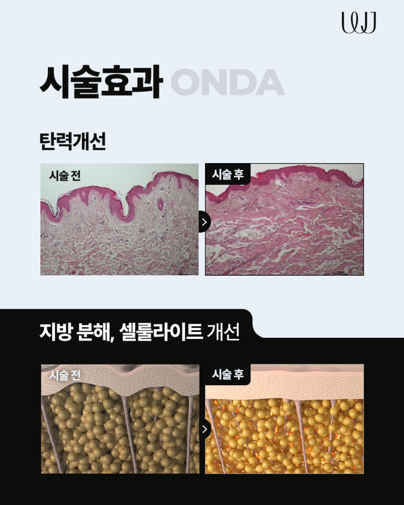 [WJ원진성형외과.피부과] 온다리프팅 바디 전용팁 12mm 보유, 얼굴부터 바디까지 사진 3