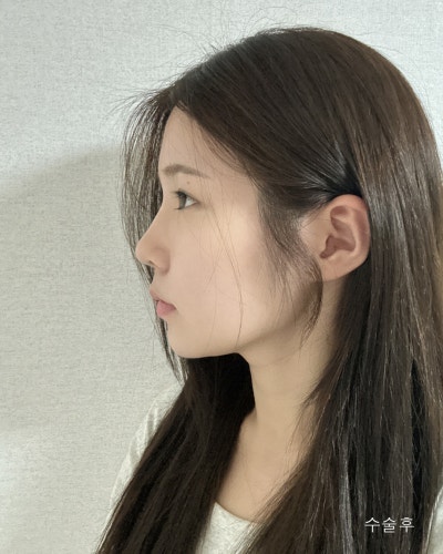 不对称大小眼修复与下垂鼻整形前后对比 사진 7