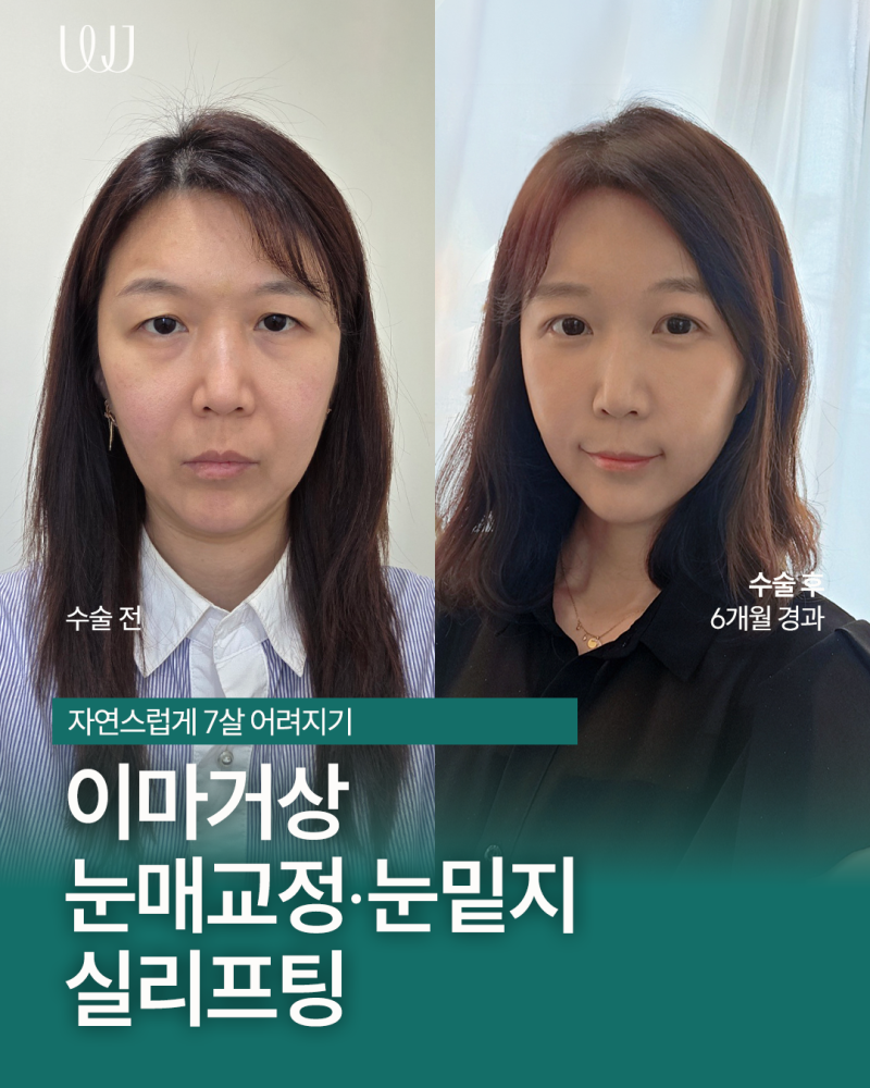 이마거상, 눈매교정, 눈밑지, 엘꿈리프팅 전후